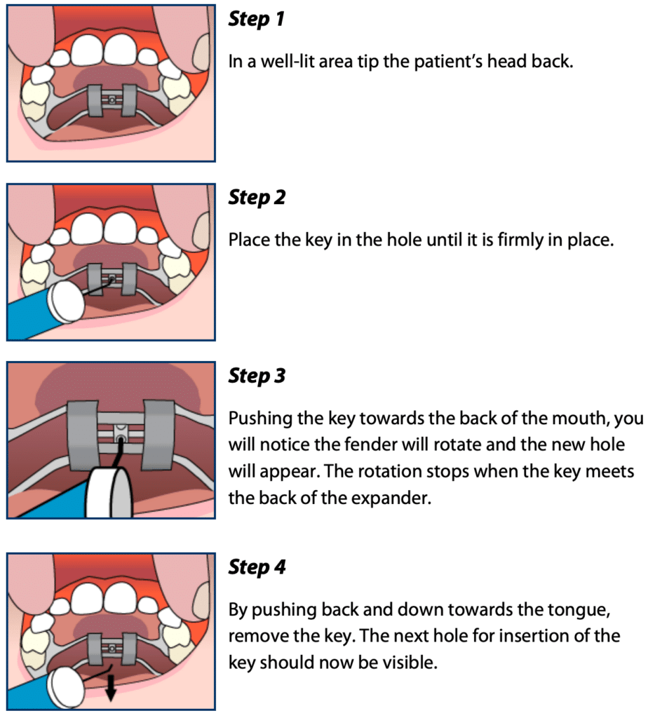 Palatal Expander in Lufkin and Nacogdoches