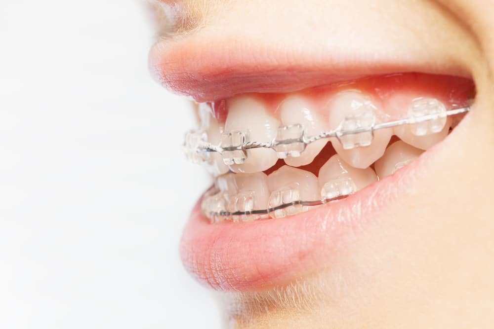 Side,View,Picture,Of,Teeth,With,Clear,Braces