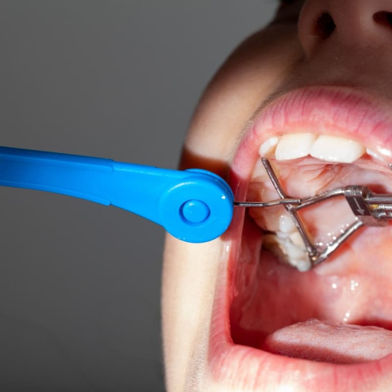 Palatal Expander Lufkin and Nacogdoches