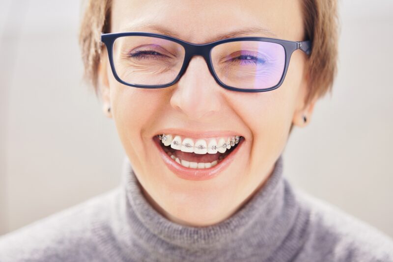 Type of Braces in Nacogdoches and Lufkin