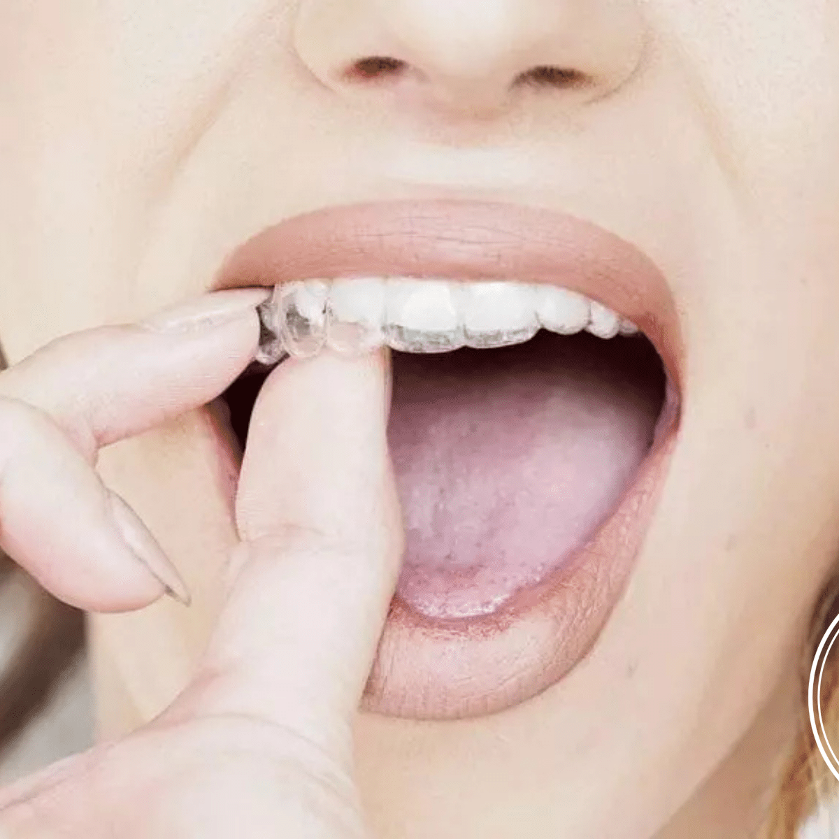 Invisalign