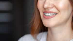 Traditional Braces Lufkin