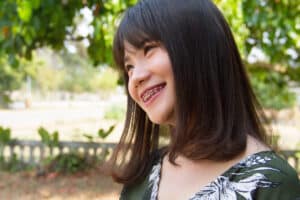 Braces for Teens Nacogdoches