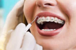 Types of Braces Lufkin