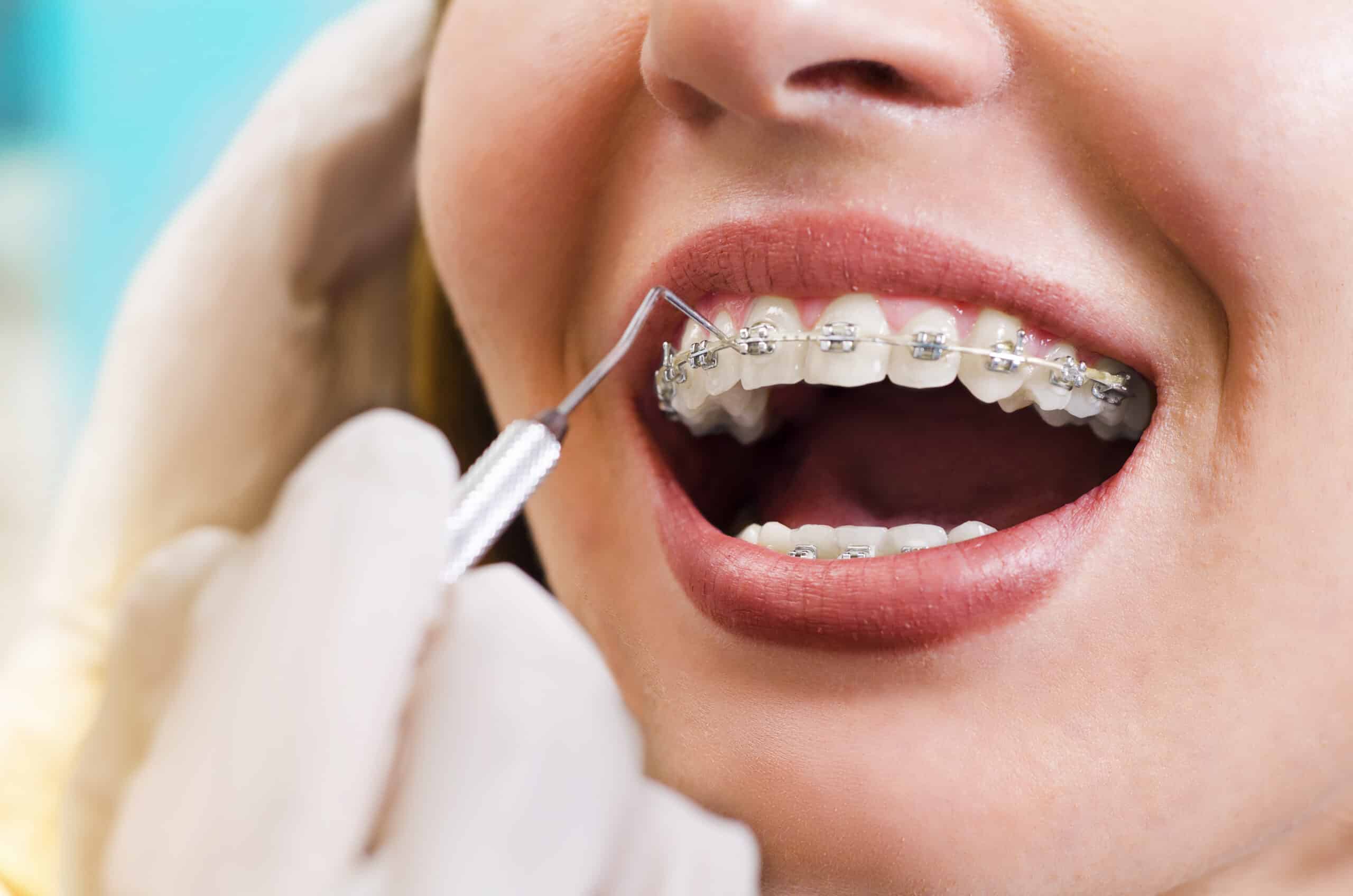 Types of Braces Lufkin