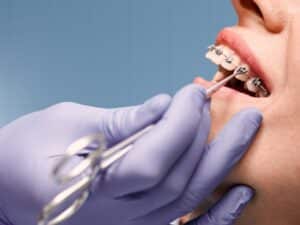 Orthodontic Treatment Nacogdoches