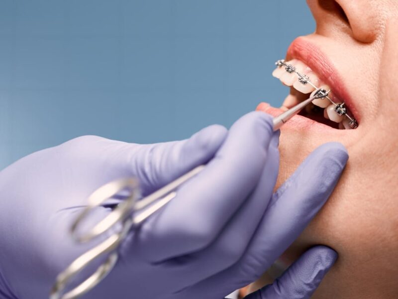 Orthodontic Treatment Nacogdoches