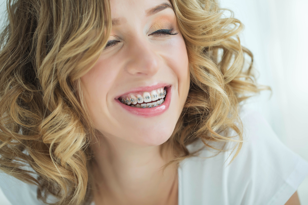 Unlock Confident Smiles With Braces Treatment in Lufkin