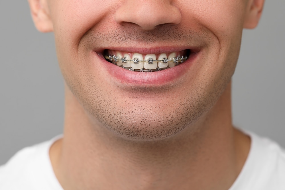 Top Orthodontist in Nacogdoches: Real Results, Real Relationships